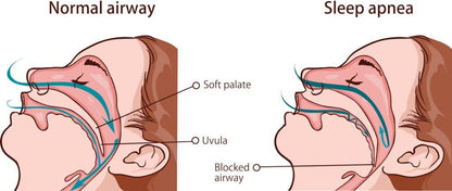 3 po Pulse Oximetry Moe Whakamātautau mo te Moe Apnea kitea